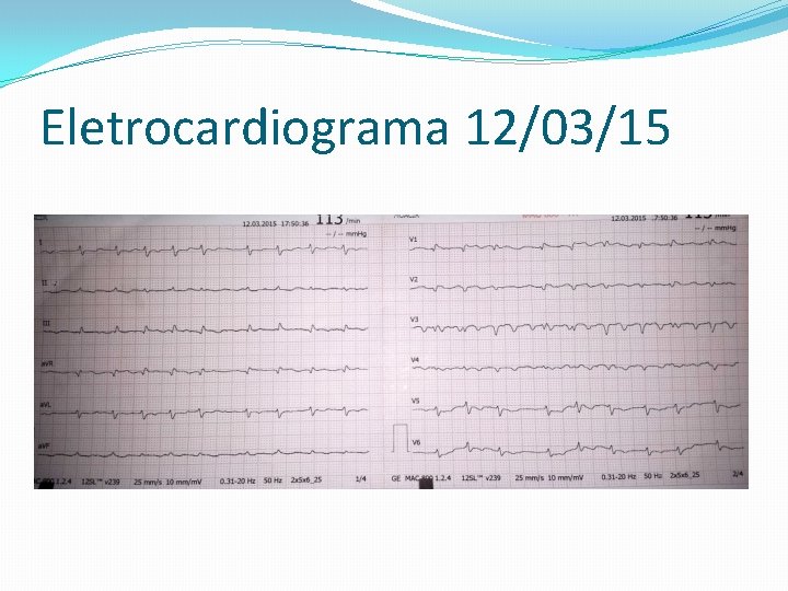 Eletrocardiograma 12/03/15 