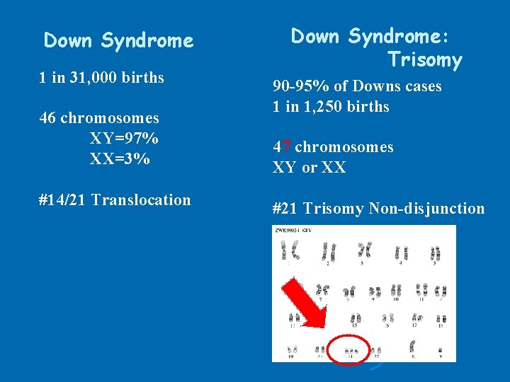 Down Syndrome 1 in 31, 000 births 46 chromosomes XY=97% XX=3% #14/21 Translocation Down