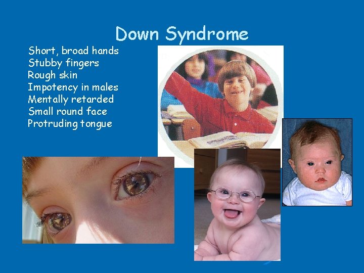 Down Syndrome Short, broad hands Stubby fingers Rough skin Impotency in males Mentally retarded