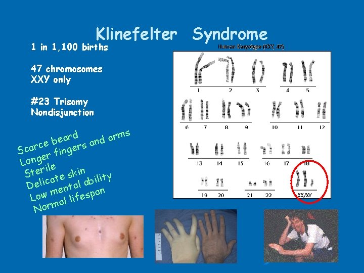 Klinefelter Syndrome 1 in 1, 100 births 47 chromosomes XXY only #23 Trisomy Nondisjunction