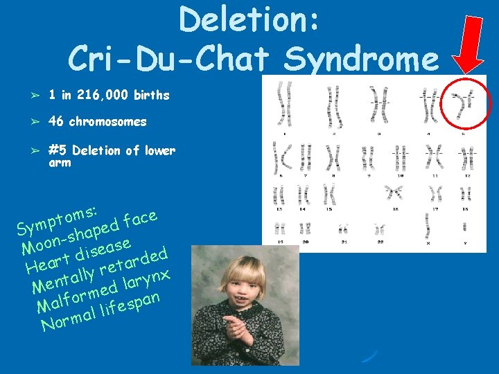 Deletion: Cri-Du-Chat Syndrome ➢ 1 in 216, 000 births ➢ 46 chromosomes ➢ #5