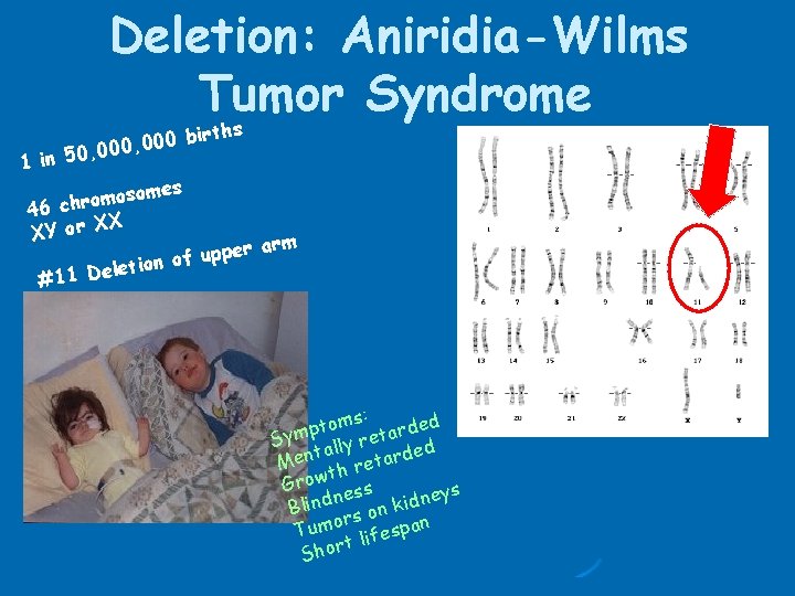 Deletion: Aniridia-Wilms Tumor Syndrome ths r i b 0 0 000, 0 , 1