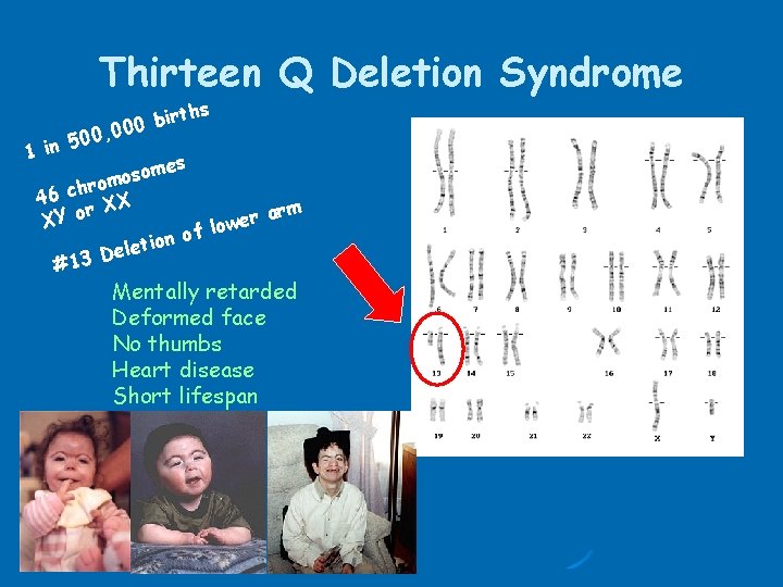 Thirteen Q Deletion Syndrome ths r i b 000 , 0 0 5 1