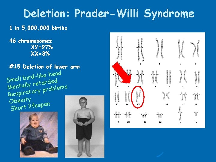 Deletion: Prader-Willi Syndrome 1 in 5, 000 births 46 chromosomes XY=97% XX=3% #15 Deletion