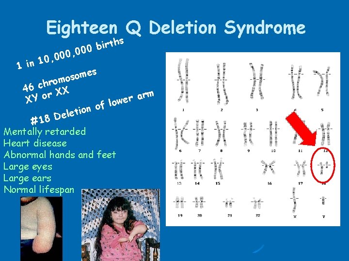 Eighteen Q Deletion Syndrome ths r i b 000 , 0 0 10, 0