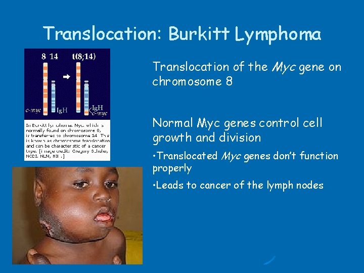 Translocation: Burkitt Lymphoma Translocation of the Myc gene on chromosome 8 Normal Myc genes