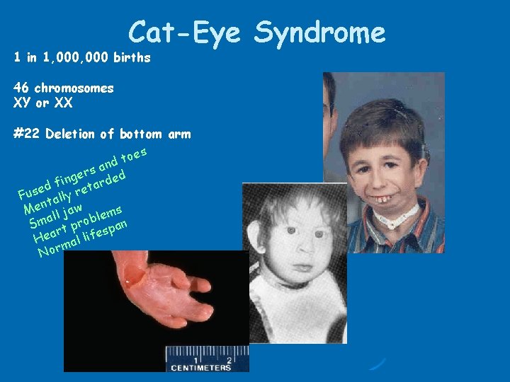 Cat-Eye Syndrome 1 in 1, 000 births 46 chromosomes XY or XX #22 Deletion