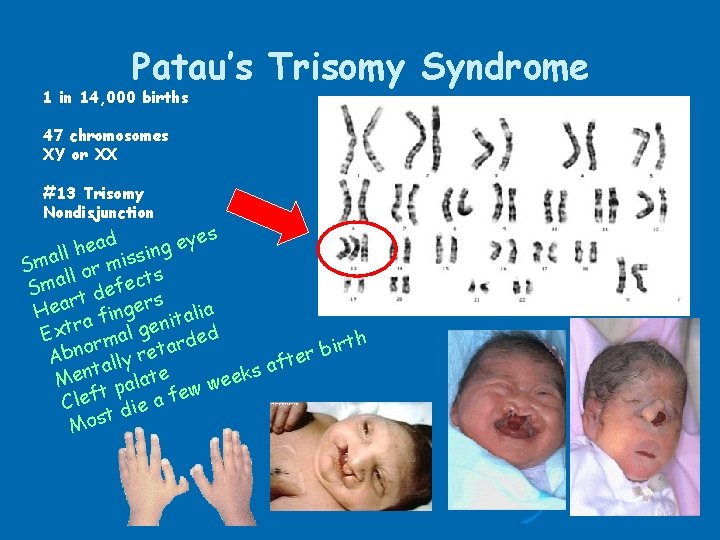 Patau’s Trisomy Syndrome 1 in 14, 000 births 47 chromosomes XY or XX #13