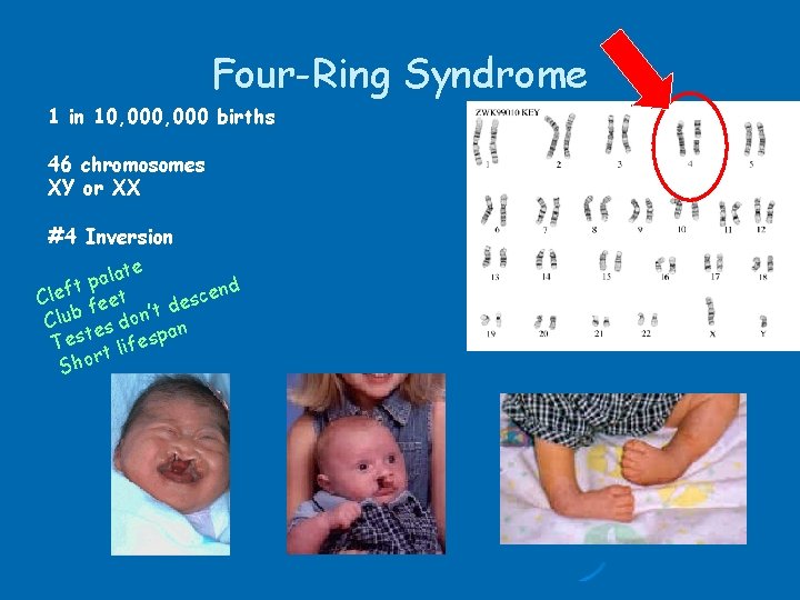 Four-Ring Syndrome 1 in 10, 000 births 46 chromosomes XY or XX #4 Inversion