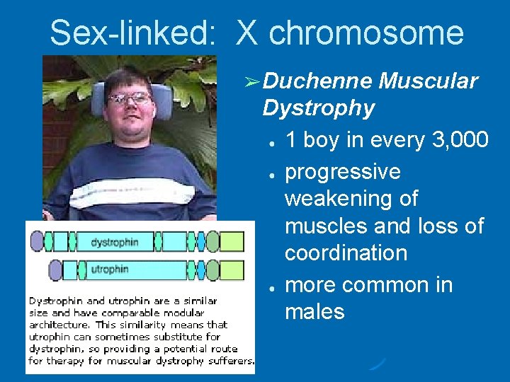 Sex-linked: X chromosome ➢ Duchenne Muscular Dystrophy ● 1 boy in every 3, 000