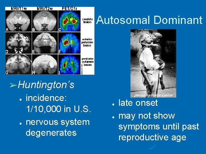 Autosomal Dominant ➢Huntington’s ● ● incidence: 1/10, 000 in U. S. nervous system degenerates