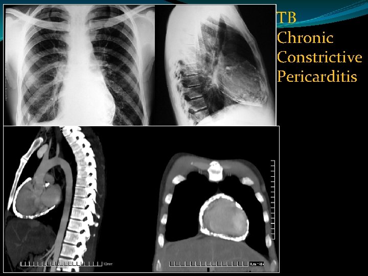 TB Chronic Constrictive Pericarditis 