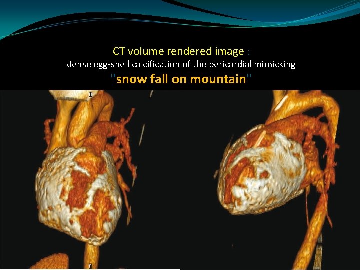 CT volume rendered image : dense egg-shell calcification of the pericardial mimicking "snow fall
