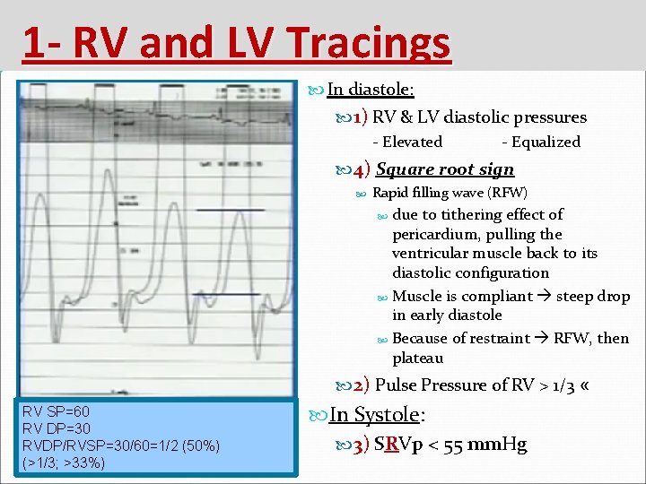 1 - RV and LV Tracings In diastole: 1) RV & LV diastolic pressures