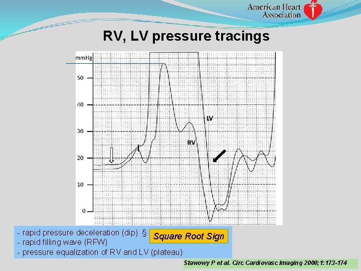 RV, LV pressure tracings - rapid pressure deceleration (dip) § Square Root Sign -