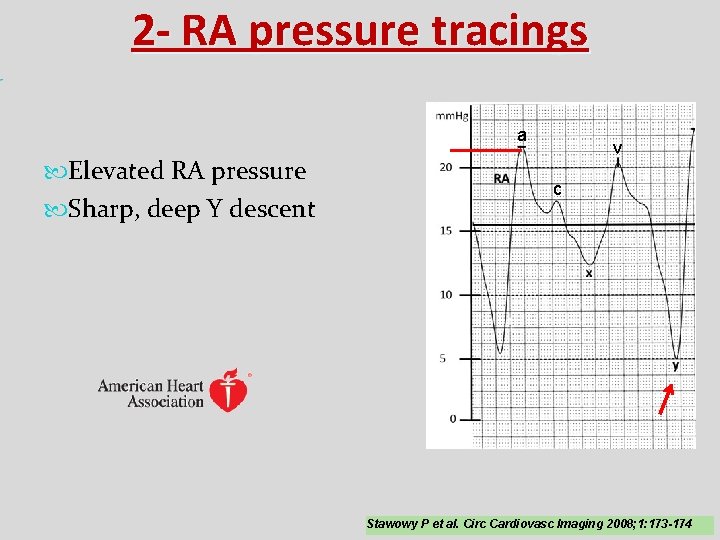 2 - RA pressure tracings a Elevated RA pressure Sharp, deep Y descent v