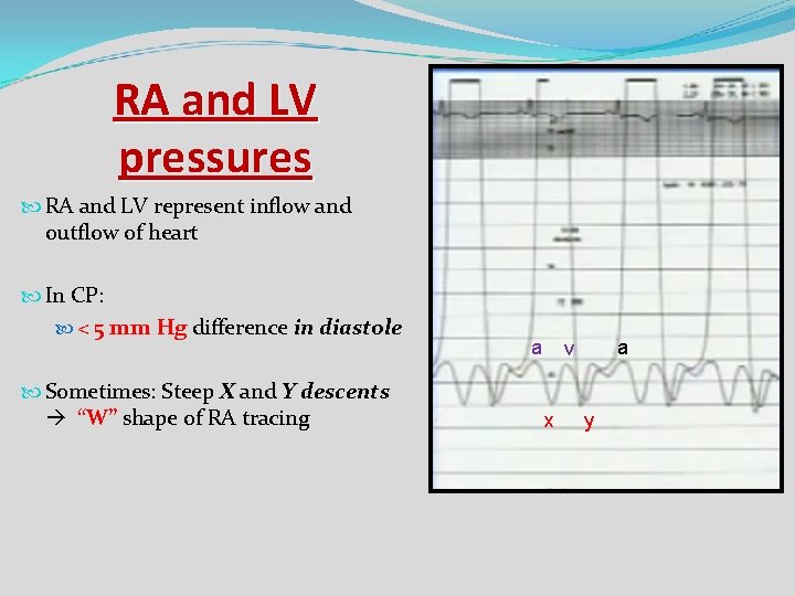 RA and LV pressures RA and LV represent inflow and outflow of heart In