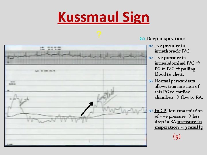 Kussmaul Sign ? Deep inspiration: - ve pressure in intrathoracic IVC + ve pressure