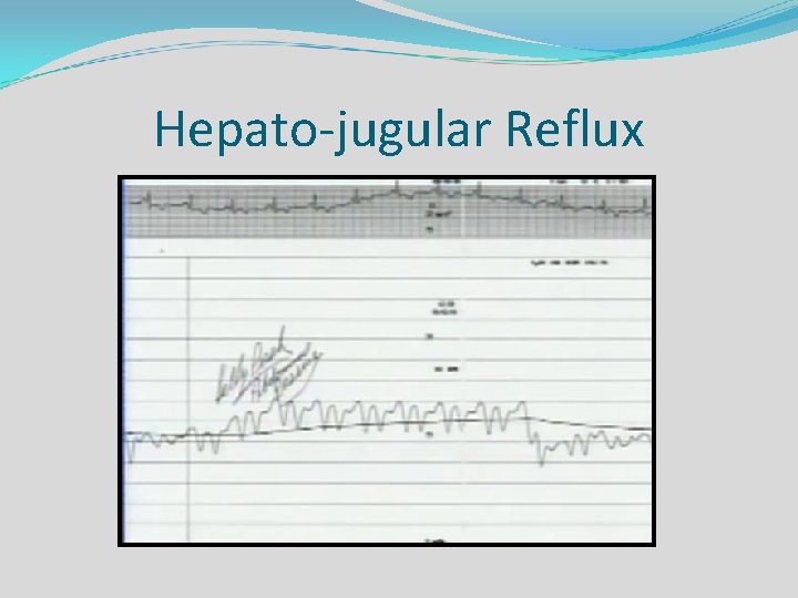 Hepato-jugular Reflux 
