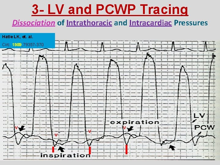 3 - LV and PCWP Tracing Dissociation of Intrathoracic and Intracardiac Pressures Hatle LK,