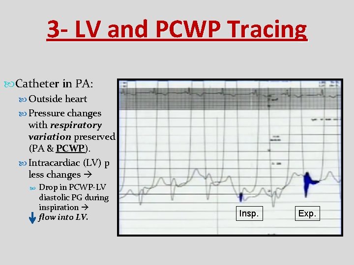 3 - LV and PCWP Tracing Catheter in PA: Outside heart Pressure changes with