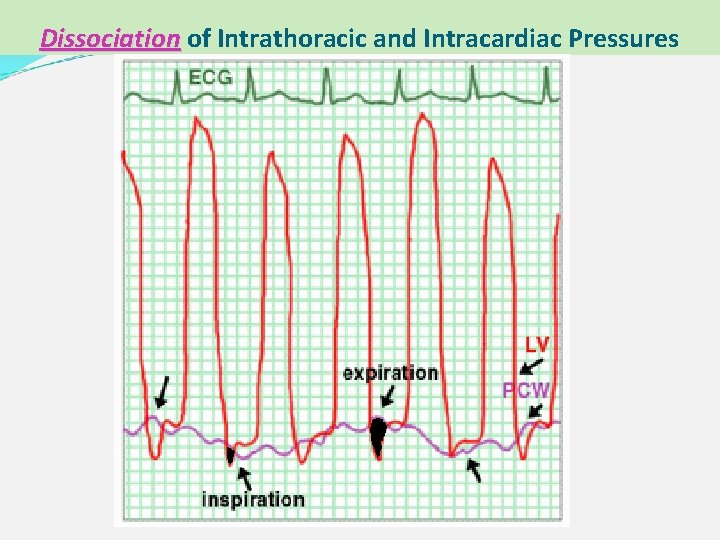 Dissociation of Intrathoracic and Intracardiac Pressures 