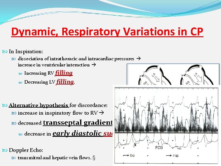 Dynamic, Respiratory Variations in CP In Inspiration: dissociation of intrathoracic and intracardiac pressures increase
