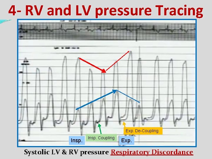 4 - RV and LV pressure Tracing Exp. De-Coupling Insp. Coupling Exp. Systolic LV