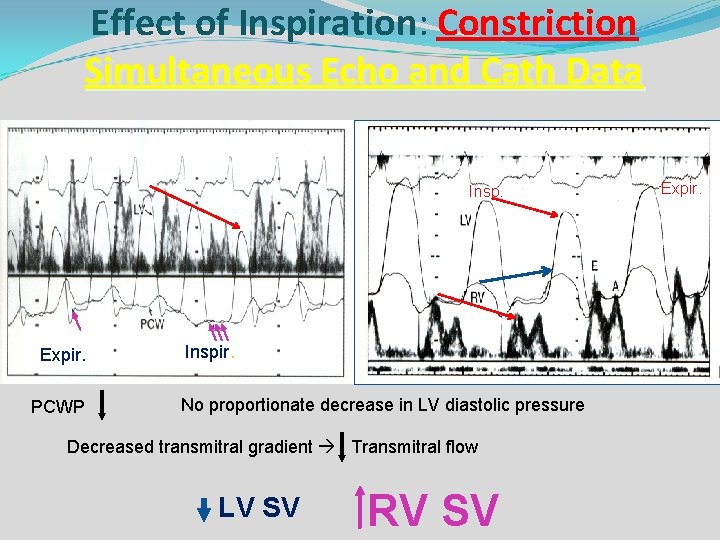 Effect of Inspiration: Constriction Simultaneous Echo and Cath Data Expir. Inspir. Expir. PCWP Inspir.