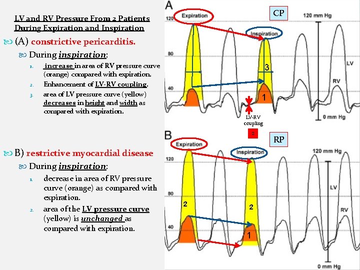 CP LV and RV Pressure From 2 Patients During Expiration and Inspiration (A) constrictive