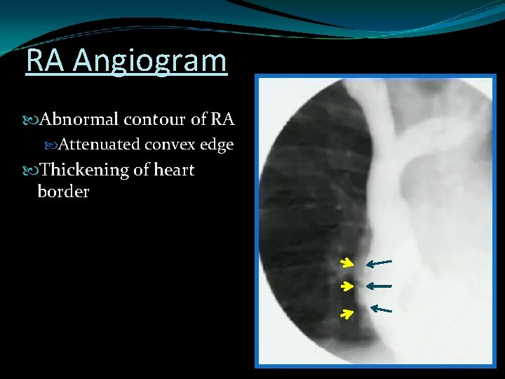 RA Angiogram Abnormal contour of RA Attenuated convex edge Thickening of heart border 