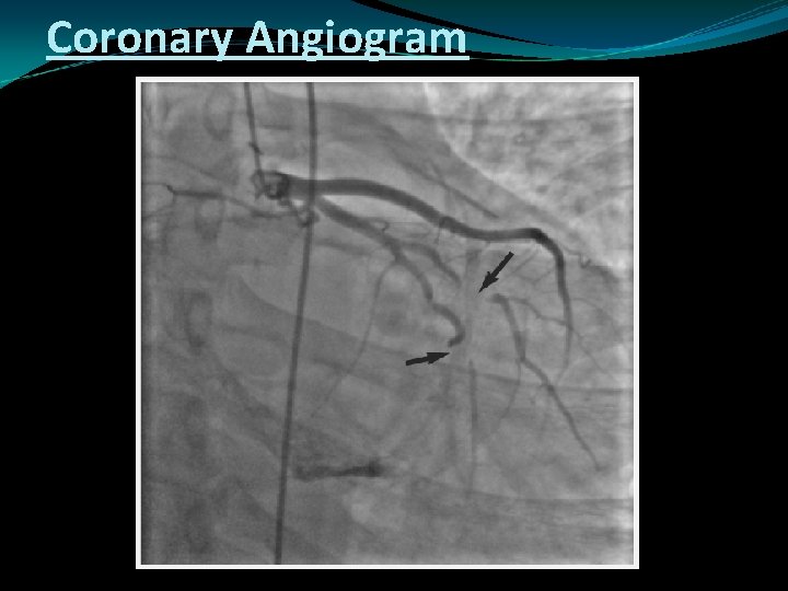 Coronary Angiogram 