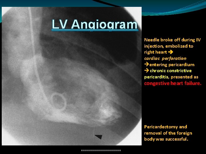 LV Angiogram Needle broke off during IV injection, embolized to right heart cardiac perforation