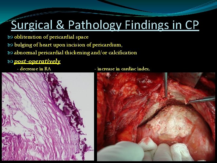 Surgical & Pathology Findings in CP obliteration of pericardial space bulging of heart upon