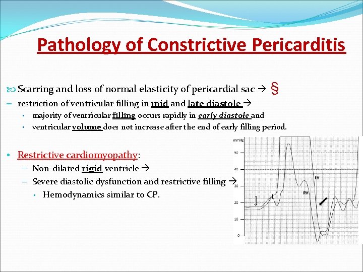 Pathology of Constrictive Pericarditis Scarring and loss of normal elasticity of pericardial sac §