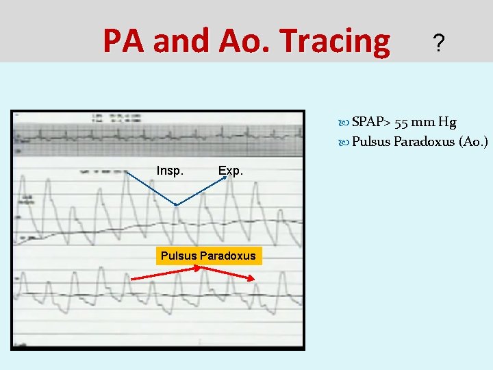 PA and Ao. Tracing ? SPAP> 55 mm Hg Pulsus Paradoxus (Ao. ) Insp.