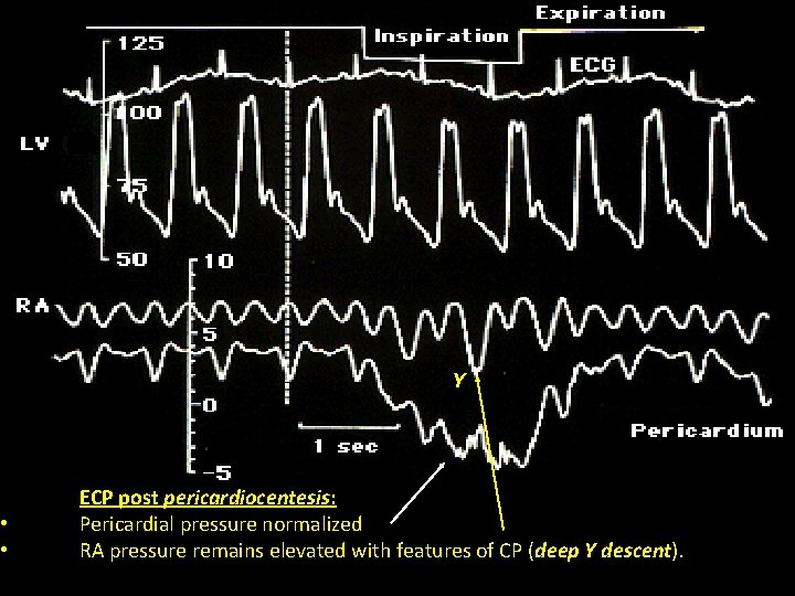  • • Y ECP post pericardiocentesis: Pericardial pressure normalized RA pressure remains elevated
