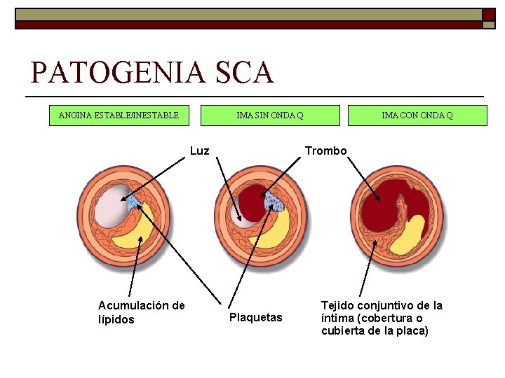 PATOGENIA SCA ANGINA ESTABLE/INESTABLE IMA SIN ONDA Q Luz Acumulación de lípidos IMA CON