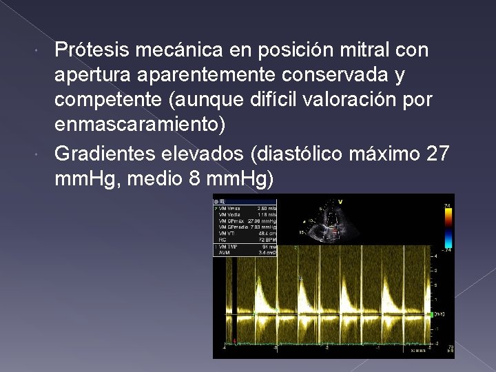 Prótesis mecánica en posición mitral con apertura aparentemente conservada y competente (aunque difícil valoración Prótesis mecánica en posición mitral con apertura aparentemente conservada y competente (aunque difícil valoración