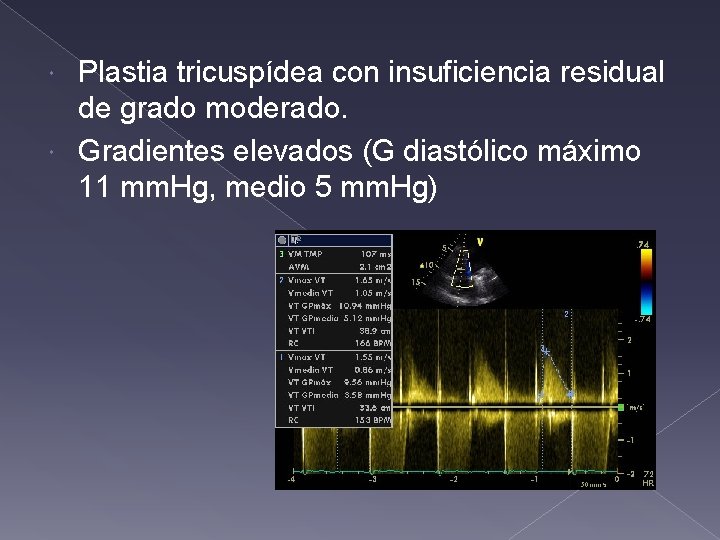 Plastia tricuspídea con insuficiencia residual de grado moderado. Gradientes elevados (G diastólico máximo 11 Plastia tricuspídea con insuficiencia residual de grado moderado. Gradientes elevados (G diastólico máximo 11