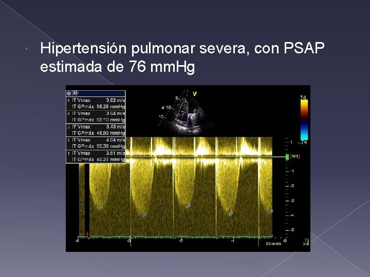 Hipertensión pulmonar severa, con PSAP estimada de 76 mm. Hg Hipertensión pulmonar severa, con PSAP estimada de 76 mm. Hg