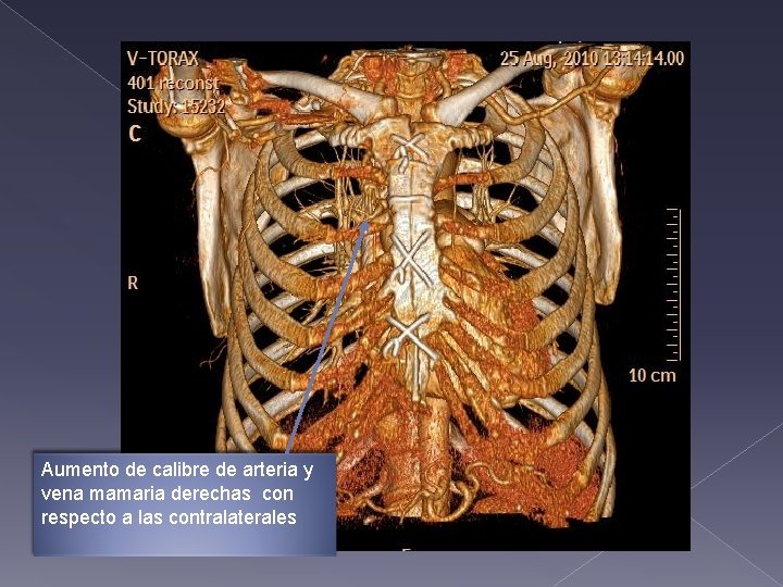 Aumento de calibre de arteria y vena mamaria derechas con respecto a las contralaterales Aumento de calibre de arteria y vena mamaria derechas con respecto a las contralaterales