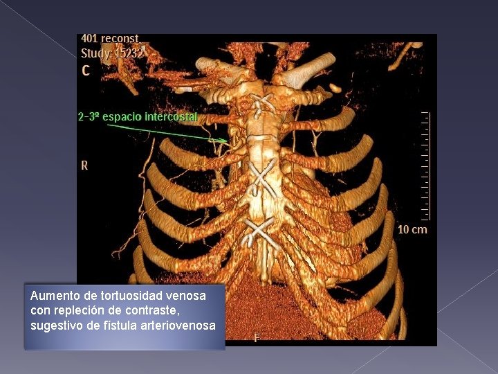 Aumento de tortuosidad venosa con repleción de contraste, sugestivo de fístula arteriovenosa Aumento de tortuosidad venosa con repleción de contraste, sugestivo de fístula arteriovenosa