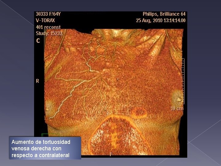 Aumento de tortuosidad venosa derecha con respecto a contralateral Aumento de tortuosidad venosa derecha con respecto a contralateral