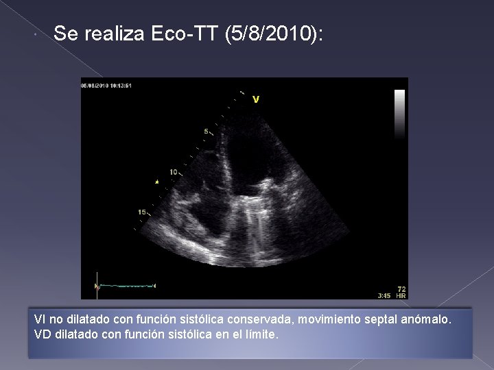 Se realiza Eco-TT (5/8/2010): VI no dilatado con función sistólica conservada, movimiento septal Se realiza Eco-TT (5/8/2010): VI no dilatado con función sistólica conservada, movimiento septal