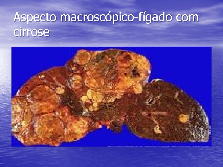 Aspecto macroscópico-fígado com cirrose 