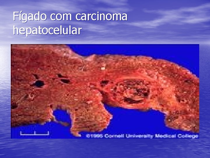 Fígado com carcinoma hepatocelular 