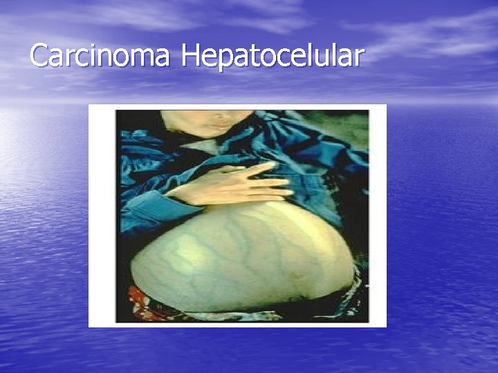 Carcinoma Hepatocelular 