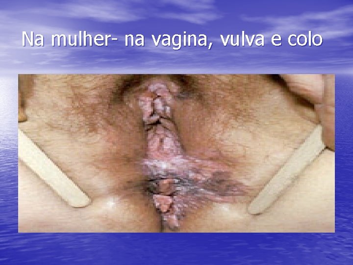 Na mulher- na vagina, vulva e colo 