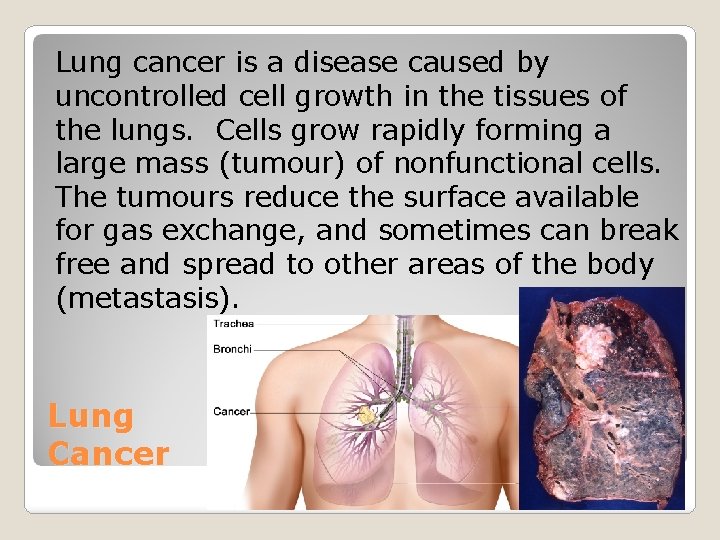 Lung cancer is a disease caused by uncontrolled cell growth in the tissues of